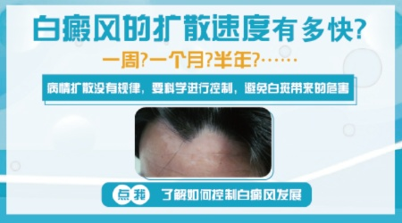 白癜风最新进展与关键信息探索，新闻头条带你了解白癜风领域动态