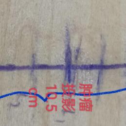 巴氏腺囊肿全解析，了解、预防与治疗策略一网打尽