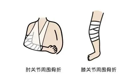 骨折康复指南最新版解读，全面洞悉骨折康复全过程