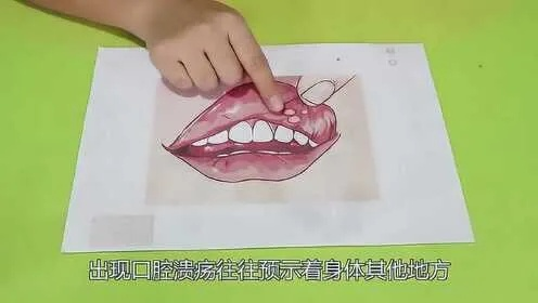 百度揭秘，溃疡成因、预防与应对方法大全