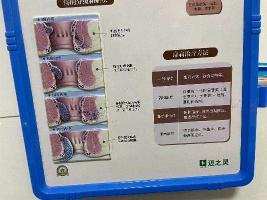 揭秘痔疮手术全过程，专业视频全方位解读治疗过程，百度收录标准标题推荐