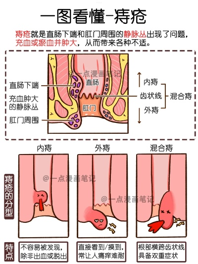 全球痔疮状况大揭秘，国家排名与现象探究